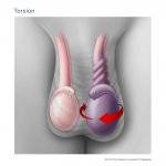 Impact de la torsion testiculaire sur la fertilité masculine